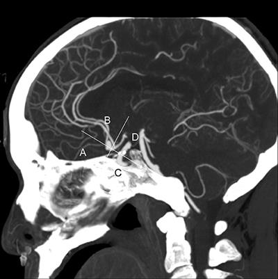 A Simple Scoring Model for Prediction of Rupture Risk of Anterior Communicating Artery Aneurysms